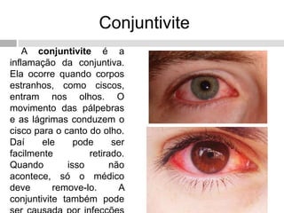 Conjuntivite
A conjuntivite é a
inflamação da conjuntiva.
Ela ocorre quando corpos
estranhos, como ciscos,
entram nos olhos. O
movimento das pálpebras
e as lágrimas conduzem o
cisco para o canto do olho.
Daí ele pode ser
facilmente retirado.
Quando isso não
acontece, só o médico
deve remove-lo. A
conjuntivite também pode
 