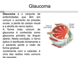 Glaucoma
Glaucoma é o conjunto de
enfermidades que têm em
comum o aumento da pressão
ocular, a perda do campo visual
e a atrofia do nervo óptico.
A forma mais comum de
glaucoma é conhecida como
glaucoma primário de ângulo
aberto. Nesta condição, o nervo
óptico é danificado lentamente e
o paciente perde a visão de
forma gradual.
Juntamente com a catarata, é
uma das razões mais comuns
 