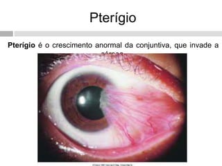 Pterígio
Pterígio é o crescimento anormal da conjuntiva, que invade a
córnea.
 