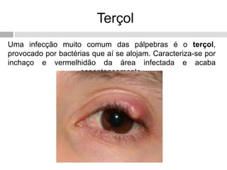 Terçol
Uma infecção muito comum das pálpebras é o terçol,
provocado por bactérias que aí se alojam. Caracteriza-se por
inchaço e vermelhidão da área infectada e acaba
espontaneamente.
 