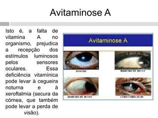 Avitaminose A
Isto é, a falta de
vitamina A no
organismo, prejudica
a recepção dos
estímulos luminosos
pelos sensores
oculares. Essa
deficiência vitamínica
pode levar à cegueira
noturna e à
xeroftalmia (secura da
córnea, que também
pode levar a perda de
visão).
 