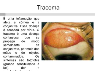 Tracoma
É uma inflamação que
afeta a córnea e a
conjuntiva. Essa doença
é causada por vírus. O
tracoma é uma doença
contagiosa que se
propaga de modo
semelhante da
conjuntivite, por meio das
mãos e de objetos
contaminados. Os
sintomas são fotofobia
(grande sensibilidade à
luz), dor e
 