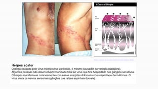 Herpes zoster
Doença causada pelo vírus Herpesvirus varicellae, o mesmo causador da varicela (catapora).
Algumas pessoas não desenvolvem imunidade total ao vírus que fica hospedado nos gânglios sensitivos.
O herpes manifesta-se cutaneamente com essas erupções dolorosas nos respectivos dermátomos. O
vírus afeta os nervos sensoriais (gânglios das raízes espinhais dorsais).
http://users.wfu.edu/butlrs4/cell/index.html
 