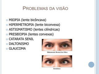 PROBLEMAS DA VISÃO
 MIOPIA (lente bicôncava)
 HIPERMETROPIA (lente biconvexa)
 ASTIGMATISMO (lentes cilíndricas)
 PRESBIOPIA (lentes convexas)
 CATARATA SENIL
 DALTONISMO
 GLAUCOMA
 