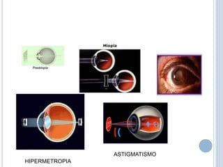 HIPERMETROPIA
ASTIGMATISMO
 