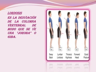 Lordosis
Es la desviación
de la columna
vertebral de
modo que se ve
una "joroba" o
Giba.
 