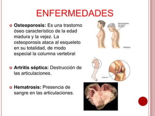 ENFERMEDADES


Osteoporosis: Es una trastorno
óseo característico de la edad
madura y la vejez. La
osteoporosis ataca al esqueleto
en su totalidad, de modo
especial la columna vertebral



Artritis séptica: Destrucción de
las articulaciones.



Hematrosis: Presencia de
sangre en las articulaciones.

 