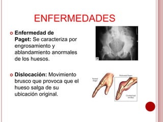 ENFERMEDADES


Enfermedad de
Paget: Se caracteriza por
engrosamiento y
ablandamiento anormales
de los huesos.



Dislocación: Movimiento
brusco que provoca que el
hueso salga de su
ubicación original.

 