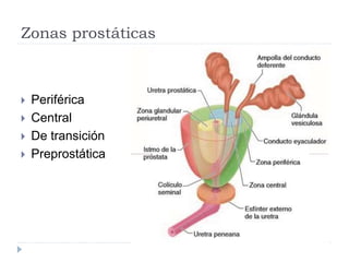 Zonas prostáticas
 Periférica
 Central
 De transición
 Preprostática
 