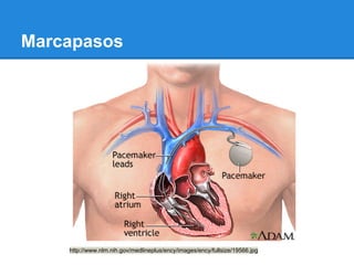 Marcapasos




    http://www.nlm.nih.gov/medlineplus/ency/images/ency/fullsize/19566.jpg
 