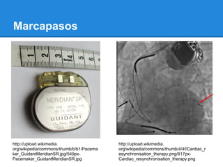 Marcapasos




http://upload.wikimedia.                  http://upload.wikimedia.
org/wikipedia/commons/thumb/b/b1/Pacema   org/wikipedia/commons/thumb/4/4f/Cardiac_r
ker_GuidantMeridianSR.jpg/549px-          esynchronisation_therapy.png/617px-
Pacemaker_GuidantMeridianSR.jpg           Cardiac_resynchronisation_therapy.png
 