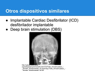 Otros dispositivos similares
● Implantable Cardiac Desfibrilator (ICD)
  desfibrilador implantable
● Deep brain stimulation (DBS)




         http://upload.wikimedia.
         org/wikipedia/commons/thumb/7/73/Tiefe_Hirnstimulation_-
         _Sonden_RoeSchaedel_ap.jpg/574px-Tiefe_Hirnstimulation_-
         _Sonden_RoeSchaedel_ap.jpg
 