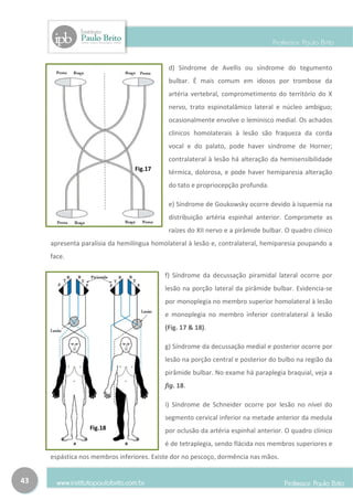 d) Síndrome de Avellis ou síndrome do tegumento
                                            bulbar. É mais comum em idosos por trombose da
                                            artéria vertebral, comprometimento do território do X
                                            nervo, trato espinotalâmico lateral e núcleo ambíguo;
                                            ocasionalmente envolve o leminisco medial. Os achados
                                            clínicos homolaterais à lesão são fraqueza da corda
                                            vocal e do palato, pode haver síndrome de Horner;
                                            contralateral à lesão há alteração da hemisensibilidade
                                 Fig.17
                                            térmica, dolorosa, e pode haver hemiparesia alteração
                                            do tato e propriocepção profunda.

                                            e) Síndrome de Goukowsky ocorre devido à isquemia na
                                            distribuição artéria espinhal anterior. Compromete as
                                            raízes do XII nervo e a pirâmide bulbar. O quadro clínico
     apresenta paralisia da hemilíngua homolateral à lesão e, contralateral, hemiparesia poupando a
     face.

                                           f) Síndrome da decussação piramidal lateral ocorre por
                                           lesão na porção lateral da pirâmide bulbar. Evidencia-se
                                           por monoplegia no membro superior homolateral à lesão
                                           e monoplegia no membro inferior contralateral à lesão
                                           (Fig. 17 & 18).

                                           g) Síndrome da decussação medial e posterior ocorre por
                                           lesão na porção central e posterior do bulbo na região da
                                           pirâmide bulbar. No exame há paraplegia braquial, veja a
                                           fig. 18.

                                           i) Síndrome de Schneider ocorre por lesão no nível do
                                           segmento cervical inferior na metade anterior da medula
                  Fig.18                   por oclusão da artéria espinhal anterior. O quadro clínico
                                           é de tetraplegia, sendo flácida nos membros superiores e
     espástica nos membros inferiores. Existe dor no pescoço, dormência nas mãos.


43
 