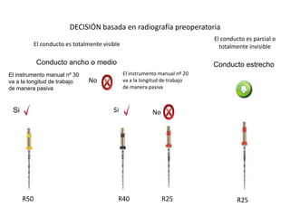 DECISIÓN basada en radiografía preoperatoria
El instrumento manual nº 20
va a la longitud de trabajo
de manera pasiva
El conducto es parcial o
totalmente invisibleEl conducto es totalmente visible
Conducto ancho o medio Conducto estrecho
El instrumento manual nº 30
va a la longitud de trabajo
de manera pasiva
No
Si Si No
R25R25R40R50
 