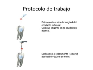 Protocolo de trabajo
Estime o determine la longitud del
conducto radicular.
Coloque irrigante en la cavidad de
acceso.
Seleccione el instrumento Reciproc
adecuado y ajuste el motor.
 