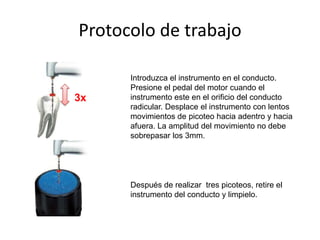 Protocolo de trabajo
3x
Introduzca el instrumento en el conducto.
Presione el pedal del motor cuando el
instrumento este en el orificio del conducto
radicular. Desplace el instrumento con lentos
movimientos de picoteo hacia adentro y hacia
afuera. La amplitud del movimiento no debe
sobrepasar los 3mm.
Después de realizar tres picoteos, retire el
instrumento del conducto y limpielo.
 