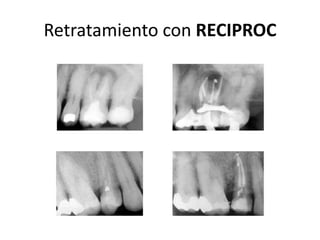 Retratamiento con RECIPROC
 