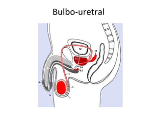 Bulbo-uretral
 