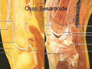 Osso Sesamóide 