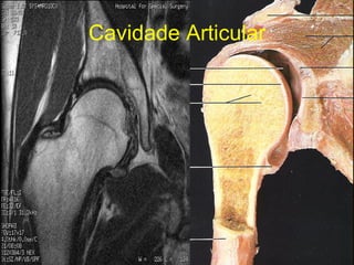 Cavidade Articular 