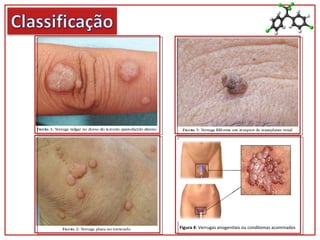 Figura 4: Verrugas anogenitais ou condilomas acominados
 