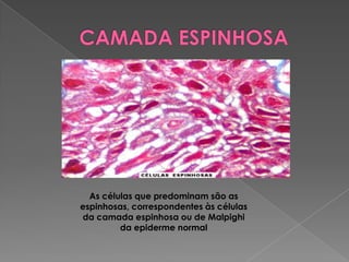 As células que predominam são as
espinhosas, correspondentes às células
da camada espinhosa ou de Malpighi
da epiderme normal
 