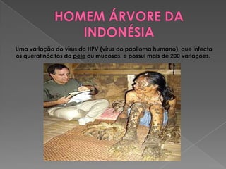 Uma variação do vírus do HPV (vírus do papiloma humano), que infecta
os queratinócitos da pele ou mucosas, e possui mais de 200 variações.
 