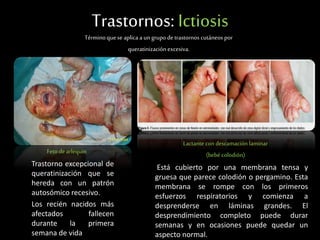 Trastornos: Ictiosis
Términoquese aplica a un grupo detrastornos cutáneos por
queratinización excesiva.
Feto de arlequin
Trastorno excepcional de
queratinización que se
hereda con un patrón
autosómico recesivo.
Los recién nacidos más
afectados fallecen
durante la primera
semana de vida
Lactante con descamación laminar
(bebé colodión)
Está cubierto por una membrana tensa y
gruesa que parece colodión o pergamino. Esta
membrana se rompe con los primeros
esfuerzos respiratorios y comienza a
desprenderse en láminas grandes. El
desprendimiento completo puede durar
semanas y en ocasiones puede quedar un
aspecto normal.
 