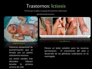 Trastornos: Ictiosis
Términoquese aplica a un grupo detrastornos cutáneos por
queratinización excesiva.
Feto de arlequin
Trastorno excepcional de
queratinización que se
hereda con un patrón
autosómico recesivo.
Los recién nacidos más
afectados fallecen
durante la primera
semana de vida
Ictosis laminar,
Parece un bebé colodión pero las escamas
permanecen. El crecimiento del pelo y
desarrollo de las glándulas sudoríparas se ve
restringido.
 