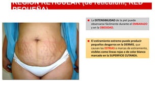 REGION RETICULAR (de reticulum, RED
PEQUEÑA)
La EXTENSIBILIDAD de la piel puede
observarse fácilmente durante el EMBARAZO
y en la OBESIDAD.

El estiramiento extremo puede producir
pequeños desgarros en la DERMIS, que
causan las ESTRIAS o marcas de estiramiento,
visibles como líneas rojas o de color blanco
marcado en la SUPERFICIE CUTANEA.

 