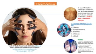 Esclerodermia
Es una enfermedad
crónica que hace que la
piel se torne gruesa y se
endurezca, provoca una
acumulación de tejido
cicatrizante y produce
daño a los órganos
internos.
Los ORGANOS INTERNOS afectados
son:
1.-CORAZON.
2.- VASOS SANGUINEOS.
3.- PULMONES.
4.-ESTOMAGO.
5.-RIÑONES.
SINTOMAS:

ESCLERODERMIA

1.-Fenomeno de Raynaud (cambios
de color: azul, blanco y rojo que se
producen en los dedos de las manos.
2.-Engrosamiento, hinchazón y
endurecimiento de la piel.
3.- Problemas del tracto digestivo
como dificultad para tragar alimentos
y problemas para absorber los
alimentos que ocasiona una pérdida
de peso.

 