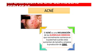 INFLAMACION DE LAS GLANDULAS
SEBACEAS
ACNÉ

El ACNÉ es una INFLAMACIÓN
de las GLÁNDULAS SEBÁCEAS
que normalmente comienza en
la pubertad cuando estas
aumentan de tamaño y empieza
la producción de SEBO.

 