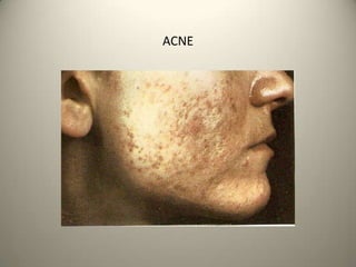 Dermis  e  HipodermisSon las  capas mas profundas y gruesa de la piel.Está compuesta por tejido conectivo que le proporciona la elasticidad y resistencia.Su base es blanca y rica en grasa.Tiene una gran cantidad de  vasos sanguíneos que son los que riegan las terminaciones nerviosas y la propia dermis. En ella se encuentra también se encuentra el sistema glandular de la piel