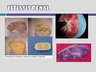 LITIASIS RENAL