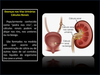 Doenças nas Vias Urinárias
Cálculos Renais
Popularmente conhecido
como "pedra nos rins", os
cálculos renais podem se
alojar nos rins, nos ureteres
ou na bexiga.
São formados na medida
em que ocorre alta
concentração de cálcio ou de
outros tipos de sal contidos
nos líquidos do organismo
(no caso a urina).
 