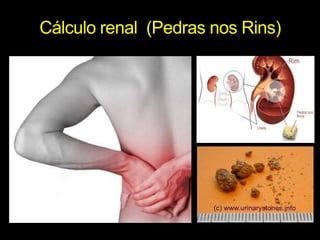 Cálculo renal  (Pedras nos Rins)