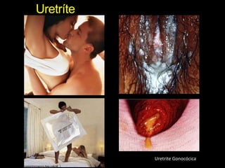 UretríteUretrite Gonocócica