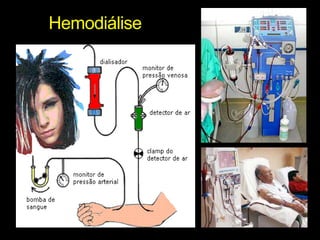 Hemodiálise
