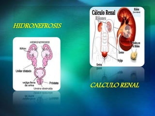 HIDRONEFROSIS
CALCULO RENAL
 