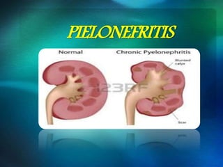 PIELONEFRITIS
 