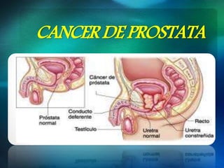 CANCER DE PROSTATA
 