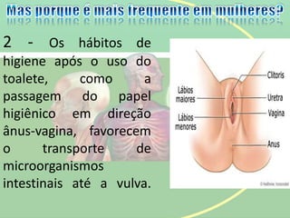2 - Os hábitos de
higiene após o uso do
toalete, como a
passagem do papel
higiênico em direção
ânus-vagina, favorecem
o transporte de
microorganismos
intestinais até a vulva.
 