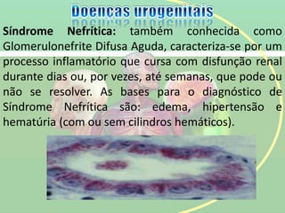 Síndrome Nefrítica: também conhecida como
Glomerulonefrite Difusa Aguda, caracteriza-se por um
processo inflamatório que cursa com disfunção renal
durante dias ou, por vezes, até semanas, que pode ou
não se resolver. As bases para o diagnóstico de
Síndrome Nefrítica são: edema, hipertensão e
hematúria (com ou sem cilindros hemáticos).
 