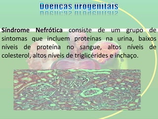 Síndrome Nefrótica consiste de um grupo de
sintomas que incluem proteínas na urina, baixos
níveis de proteína no sangue, altos níveis de
colesterol, altos níveis de triglicérides e inchaço.
 