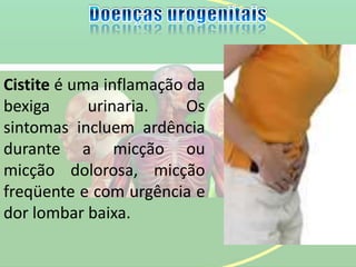Cistite é uma inflamação da
bexiga urinaria. Os
sintomas incluem ardência
durante a micção ou
micção dolorosa, micção
freqüente e com urgência e
dor lombar baixa.
 