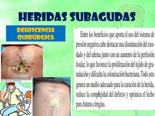 HERIDAS SUBAGUDAS
DEHISCENCIA
QUIRÚRGICA
 