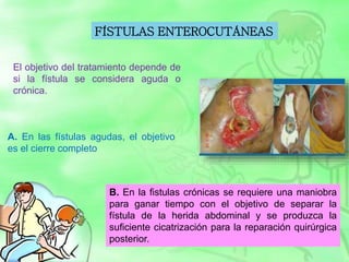 B. En la fistulas crónicas se requiere una maniobra
para ganar tiempo con el objetivo de separar la
fístula de la herida abdominal y se produzca la
suficiente cicatrización para la reparación quirúrgica
posterior.
FÍSTULAS ENTEROCUTÁNEAS
El objetivo del tratamiento depende de
si la fístula se considera aguda o
crónica.
A. En las fístulas agudas, el objetivo
es el cierre completo
 