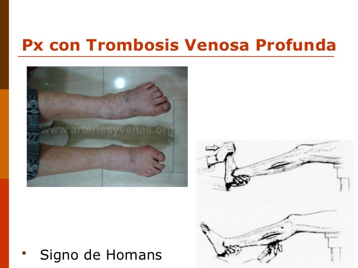 Signe Homans Prueba De Homans | Signe de Homans – RCBE