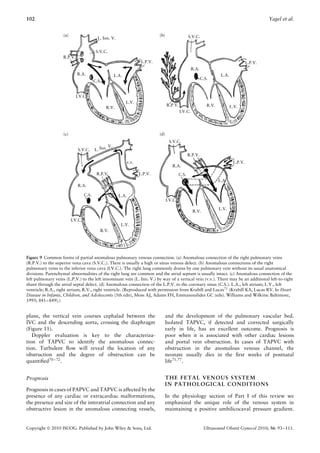 102                                                                                                                                                Yagel et al.


                    (a)                                                        (b)                   S.V.C.
                                            L. Inn. V.


                                           S.V.C.
                    R.P.V.
                                                                      L.P.V.                                                              L.P.V.
                                                                                                       R.A.
                             R.A.                      L.A.                                                              L.A.
                                                                                                              C.S.
                                          C.S.


                             I.V.C.
                                                              L.V.
                                                                                     R.P.V.                      R.V.           L.V.
                                                 R.V.
                                                                                              I.V.C.




                    (c)                                                        (d)
                                                                                      S.V.C.
                                                  V.
                              S.V.C.      L. Inn.
                                                                                                     R.P.V.
                                                              v.v.                                                               L.P.V.
                                                                                        R.A.
                                           R.P.V.                    L.P.V.                   C.S.
                                                                                                                        L.A.
                             R.A.

                                   C.S.                  L.A.
                                                                                     I.V.C.

                                                                                                                        L.V.
                                                                                                       R.V.

                          I.V.C.
                                                          L.V.
                                             R.V.




Figure 9 Common forms of partial anomalous pulmonary venous connection. (a) Anomalous connection of the right pulmonary veins
(R.P.V.) to the superior vena cava (S.V.C.). There is usually a high or sinus venous defect. (b) Anomalous connections of the right
pulmonary veins to the inferior vena cava (I.V.C.). The right lung commonly drains by one pulmonary vein without its usual anatomical
divisions. Parenchymal abnormalities of the right lung are common and the atrial septum is usually intact. (c) Anomalous connection of the
left pulmonary veins (L.P.V.) to the left innominate vein (L. Inn. V.) by way of a vertical vein (v.v.). There may be an additional left-to-right
shunt through the atrial septal defect. (d) Anomalous connection of the L.P.V. to the coronary sinus (C.S.). L.A., left atrium; L.V., left
ventricle; R.A., right atrium; R.V., right ventricle. (Reproduced with permission from Krabill and Lucas71 (Krabill KA, Lucas RV. In Heart
Disease in Infants, Children, and Adolescents (5th edn), Moss AJ, Adams FH, Emmanouilides GC (eds). Williams and Wilkins: Baltimore,
1995; 841–849).)


plane, the vertical vein courses cephalad between the                                and the development of the pulmonary vascular bed.
IVC and the descending aorta, crossing the diaphragm                                 Isolated TAPVC, if detected and corrected surgically
(Figure 11).                                                                         early in life, has an excellent outcome. Prognosis is
   Doppler evaluation is key to the characteriza-                                    poor when it is associated with other cardiac lesions
tion of TAPVC to identify the anomalous connec-                                      and portal vein obstruction. In cases of TAPVC with
tion. Turbulent ﬂow will reveal the location of any                                  obstruction in the anomalous venous channel, the
obstruction and the degree of obstruction can be                                     neonate usually dies in the ﬁrst weeks of postnatal
quantiﬁed70 – 72 .                                                                   life71,77 .


Prognosis                                                                            THE FETAL VENOUS SYSTEM
                                                                                     IN PATHOLOGICAL CONDITIONS
Prognosis in cases of PAPVC and TAPVC is affected by the
presence of any cardiac or extracardiac malformations,                               In the physiology section of Part I of this review we
the presence and size of the interatrial connection and any                          emphasized the unique role of the venous system in
obstructive lesion in the anomalous connecting vessels,                              maintaining a positive umbilicocaval pressure gradient.


Copyright  2010 ISUOG. Published by John Wiley & Sons, Ltd.                                                   Ultrasound Obstet Gynecol 2010; 36: 93–111.
 