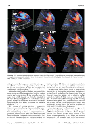 104                                                                                                                         Yagel et al.




Figure 11 Total anomalous pulmonary venous connection (infracardiac type) imaged in the sagittal plane. Tomographic ultrasound imaging
was applied in post-processing and clearly shows the vertical vein draining into one of the hepatic veins. Ao, aorta; DV, ductus venosus;
LHV, left hepatic vein; VV, vertical vein.



atrial pressure and, consequently, precordial venous pres-             resistance indices (RI) of these two compartments has been
sure. We focus here on uteroplacental insufﬁciency and                 used clinically as a monitoring tool of fetal compensatory
the gradual hemodynamic changes that accompany its                     mechanisms and the magnitude of hypoxic insult85 – 87 .
compromised vascular function.                                         The implications for the venous system of these changes
   Reduced placental supply to the fetus initiates multiple            in resistance in the different compartments are four-fold:
compensatory vasodilatory mechanisms involving various                 reduced blood supply from the placenta to the liver, an
arterial and venous systems. In the arterial system, the               increased proportion (also per unit of weight) of cardiac
organ most widely studied and clinically evaluated is                  output diverted to the fetal body and consequently to
the brain (brain-sparing effect)79,80 . Evaluation of various          the IVC, increased blood ﬂow through the SVC resulting
parts of the arterial circulation in the fetus with circulatory        from the brain-sparing effect, and an increased afterload
compromise has been widely performed and reviewed                      on the right ventricle. These hemodynamic changes lead
elsewhere81 – 84 .                                                     to increased preload indices that hamper the supply of
   The cascade of evolving circulatory compromise                      high-quality blood ﬂow from the placenta.
in uteroplacental insufﬁciency is characterized by hemo-                  Venous compensatory mechanisms aim to improve the
dynamic changes in the placenta, heart and brain. The                  placental supply to the heart by increasing the proportion
fetal circulation may be viewed as comprising two com-                 of DV shunting from the portal sinus. Human Doppler
partments, with the division at the aortic isthmus: the right          studies have reported variable results. Bellotti et al.88
ventricle/placenta, having high resistance, and the left ven-          found that the percentage of UV blood ﬂow shunted
tricle/brain, having low resistance. The ratio between the             through the DV increased from 26.5% in normally


Copyright  2010 ISUOG. Published by John Wiley & Sons, Ltd.                              Ultrasound Obstet Gynecol 2010; 36: 93–111.
 